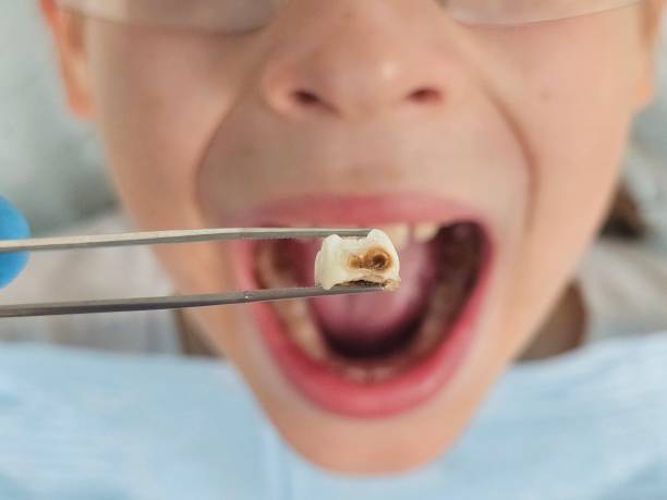 Best Knocked-Out Tooth Emergency  in Highlands, TX